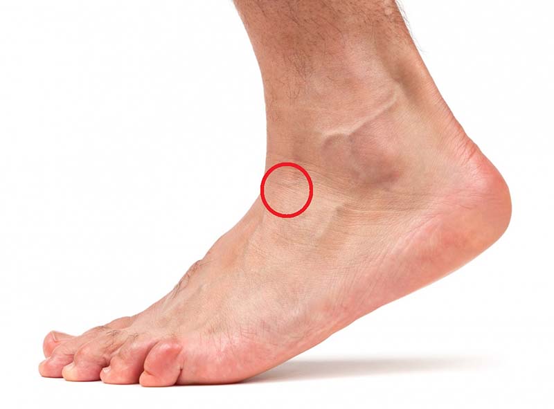 Extracción de cuerpo extraño superficial en piel o tejido celular subcutáneo