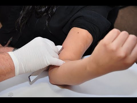 Inserción y extracción de implante hormonal subdérmico