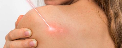 Cauterización de lesiones, verrugas, lunares